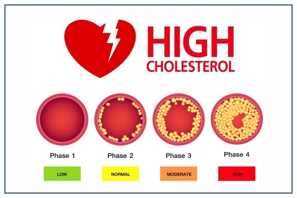 High Cholesterol: गर्मियों में कोलेस्ट्रॉल लेवल को कैसे कंट्रोल करें ?