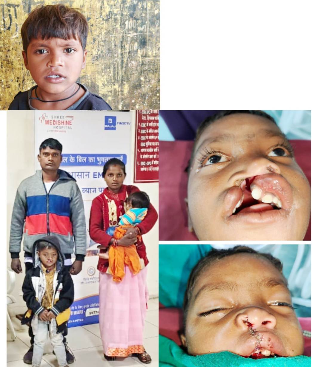 CG News: बस्तर के वनांचल में चिरायु योजना बनी वरदान, सफल ऑपरेशन के बाद मुस्कुरा रहा नन्हा विक्रम